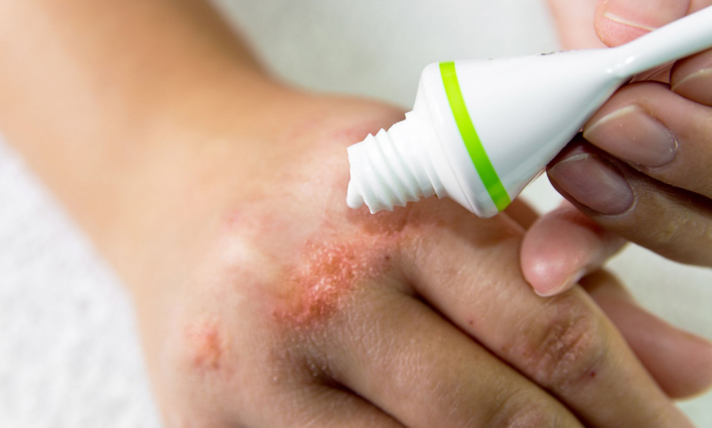 All In One Benefits Of Ketoconazole Cream