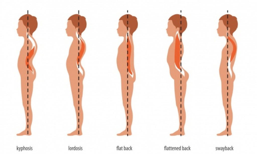 Spine Problems: How To Get Rid Of Them?