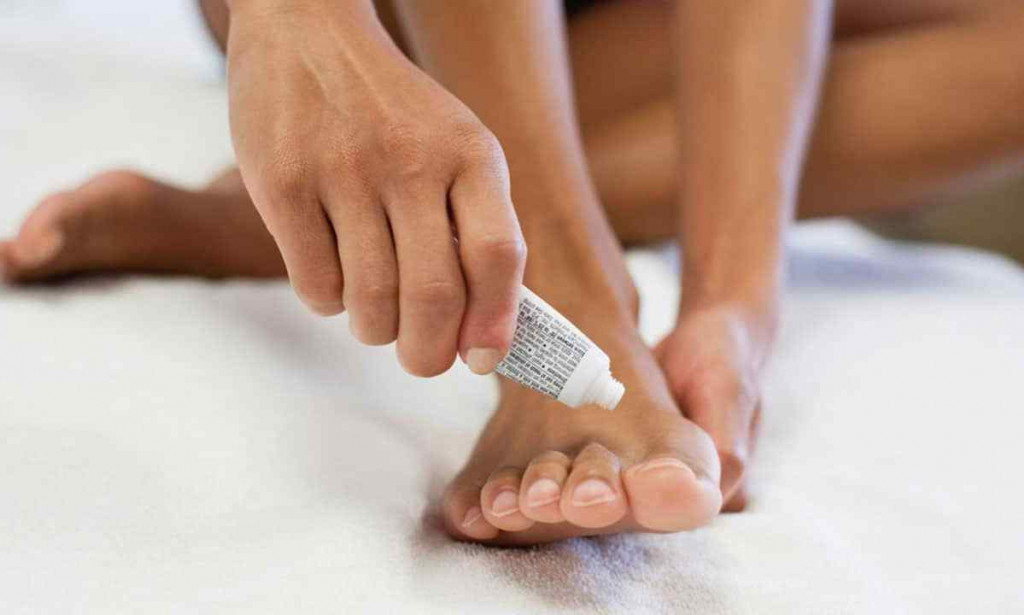 Applying the ketoconazole cream for treating toenail fungal infection
