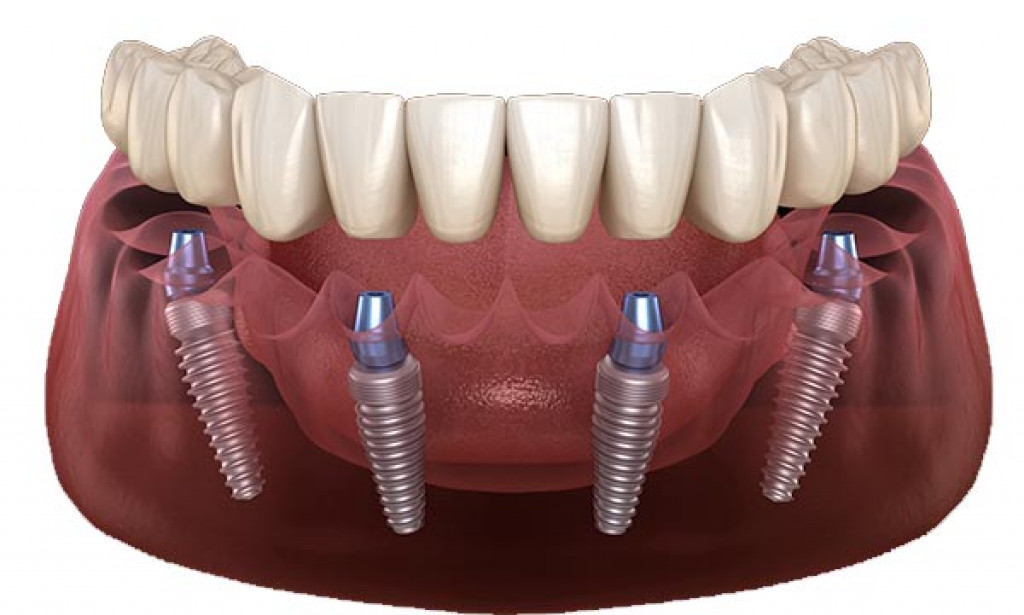 Time Needed for All-on-4 Implant Procedure